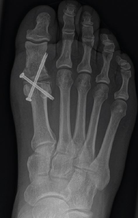 Röntgenbild des Fußes von oben, man sieht die beiden Schrauben, die das Grundgelenk der großen Zehe fixieren
