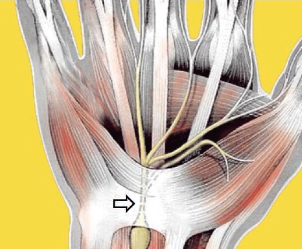 anatomische Zeichnung der Hand, ein Pfeil markiert den Karpaltunnel