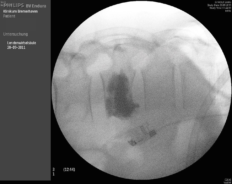 Intraoperatives Röntgenbild: zementierter Wirbelkörper